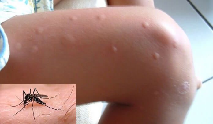 heridas por mordedura mosquito